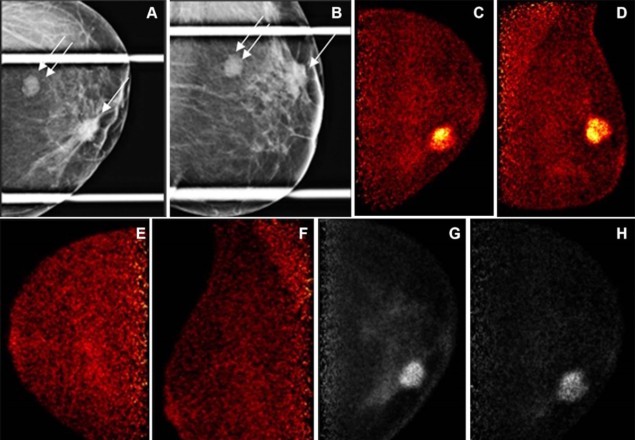 Breast cancer imaging