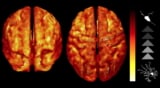 Imaging brain inflammation