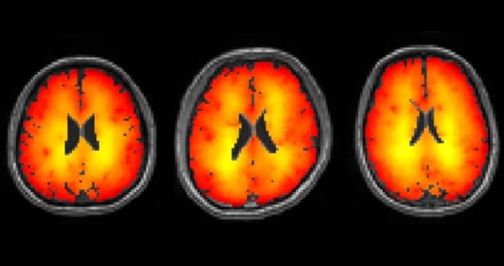 Mapping brain temperature