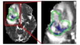 Apparent diffusion coefficient maps recorded on an MR-Linac