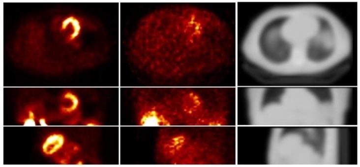 SPECT reconstructions