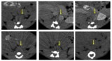 CT imaging with gold nanoparticles