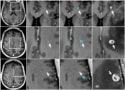 Computer-aided detection of brain metastases