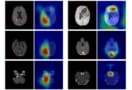 Brain tumour classification