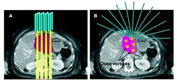 LATTICE radiotherapy