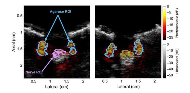 Photoacoustic images of the ulnar and median nerves from a pig