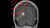 Minimally invasive image-guided ablation