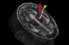 Diffusion tractography