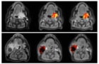 Tumour oxygenation measurements