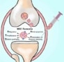 MSC exosomes repair cartilage