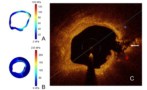 Predicting plaque rupture