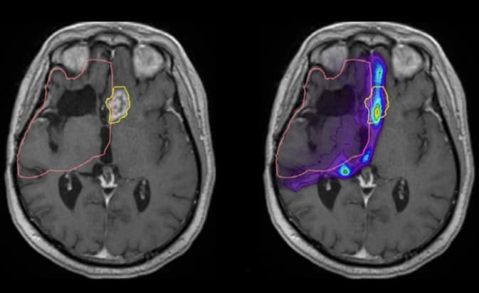 MRI changes